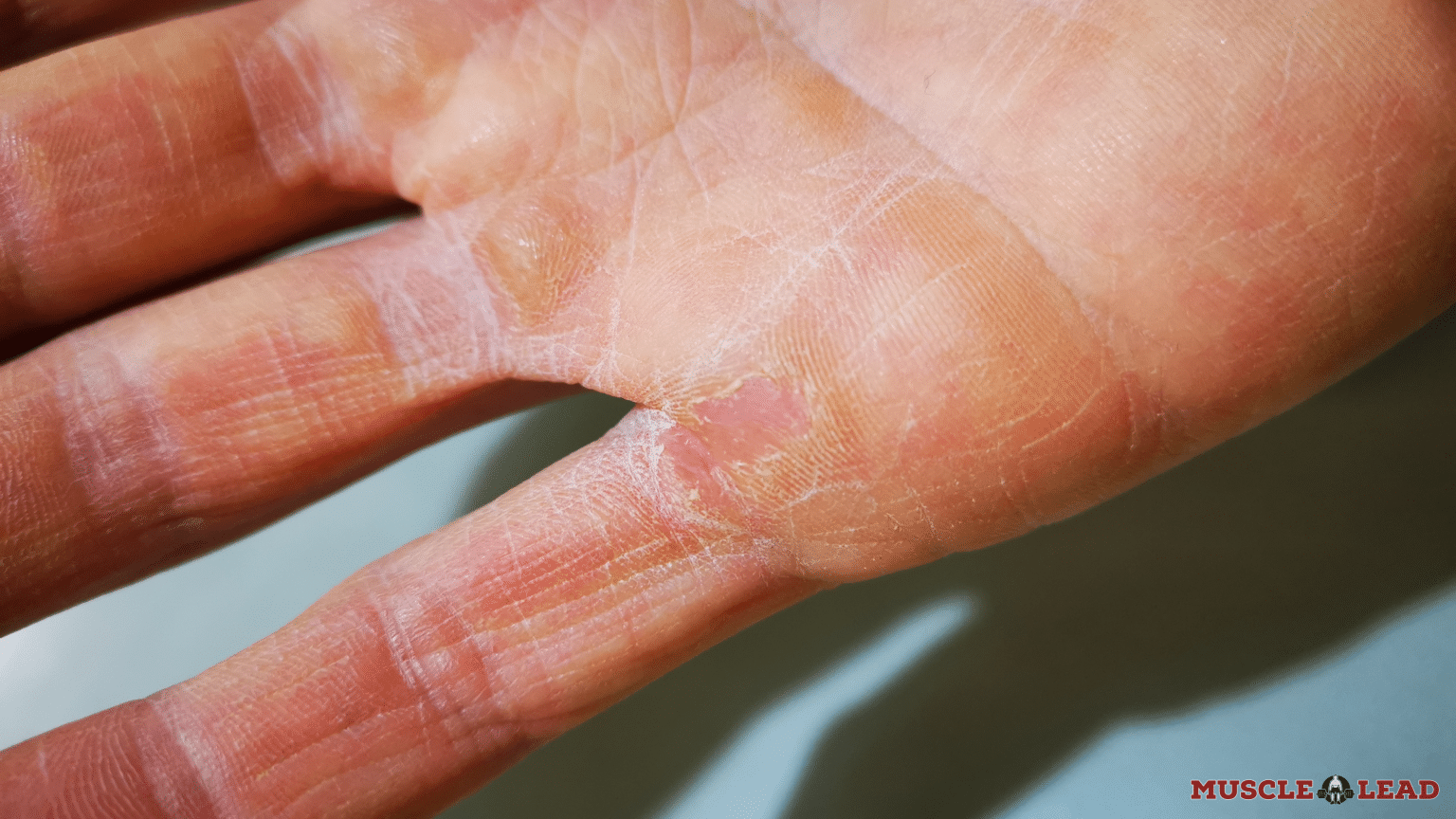 10 Common Deadlift Injuries (+ How To Avoid Them)